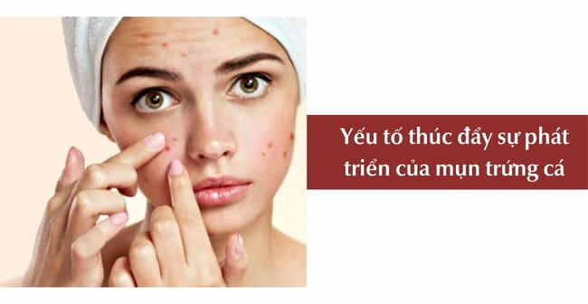 Yếu tố thúc đẩy sự phát triển của mụn trứng cá:
