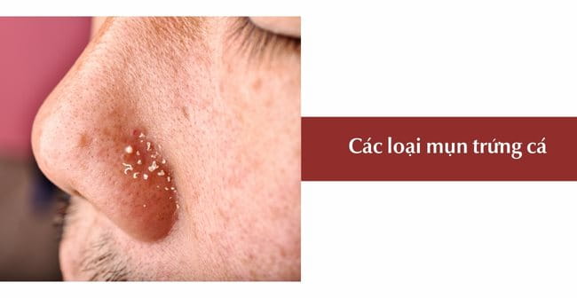 Các loại mụn trứng cá