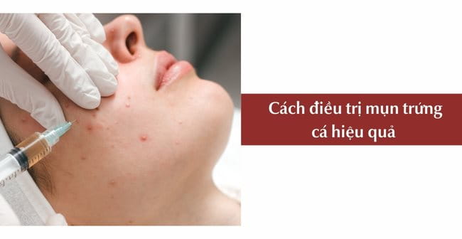 Cách điều trị mụn trứng cá nặng