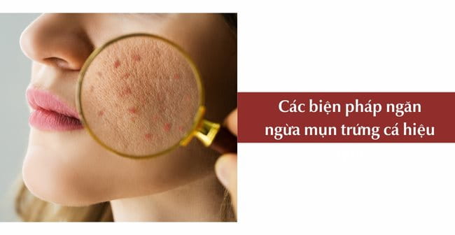 Các biện pháp ngăn ngừa mụn trứng cá hiệu quả