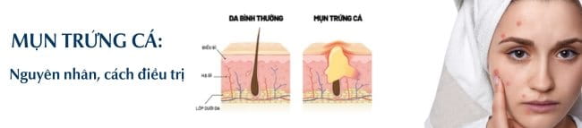 Mụn trứng cá: Nguyên nhân, cách điều trị