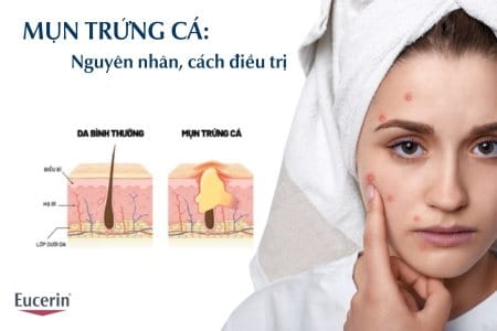 Mụn trứng cá là gì? Nguyên nhân, cách điều trị