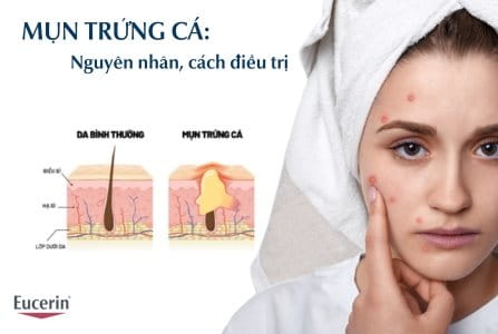 Mụn trứng cá là gì? Nguyên nhân, cách điều trị