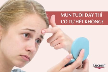 Mụn tuổi dậy thì có tự hết không, kéo dài bao lâu và khi nào hết?