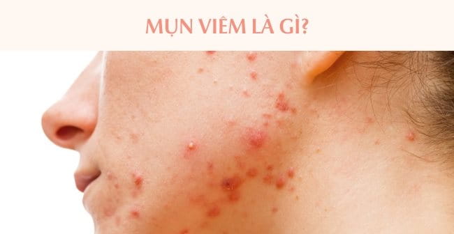 Mụn viêm là gì?