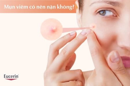 Mụn viêm có nên nặn không? Cách điều trị mụn viêm an toàn tại nhà