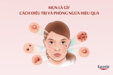 Mụn là gì?