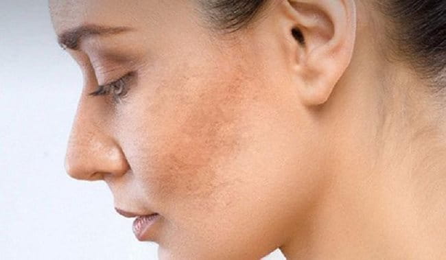 Nám da mặt vùng má rất dễ gặp ở nhiều người 