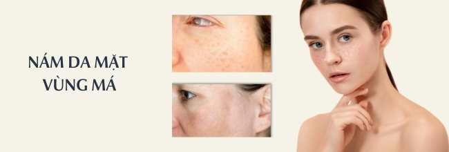nám da mặt vùng má