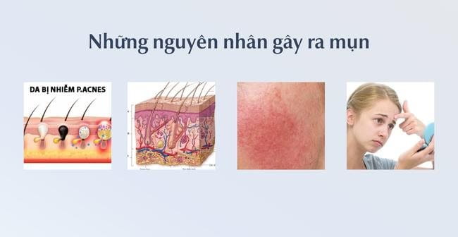Những nguyên nhân gây mụn