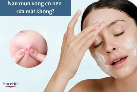Nặn mụn xong có nên rửa mặt không?