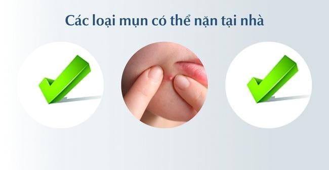 Các loại mụn có thể tự nặn tại nhà