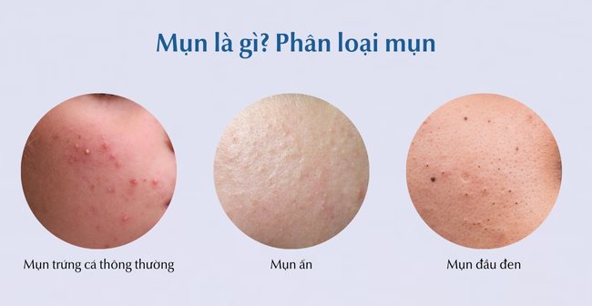 Mụn là gì? Phân loại mụn