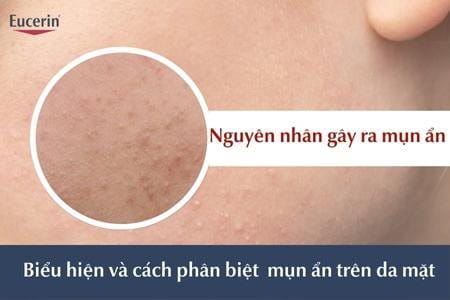 Mụn ẩn nguyên nhân và cách điều trị
