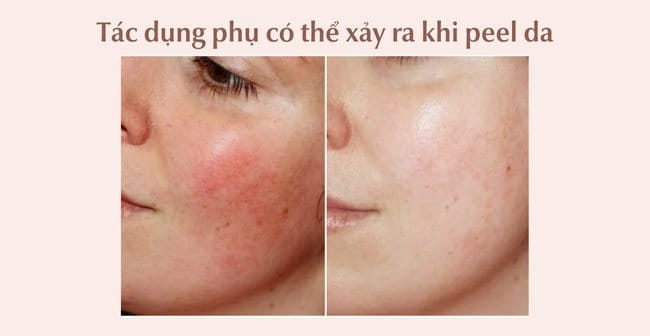 Tác dụng phụ có thể xảy ra khi thực hiện peel da
