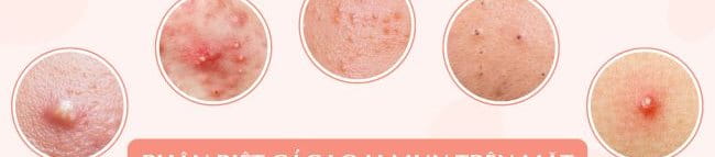 phân biệt các loại mụn