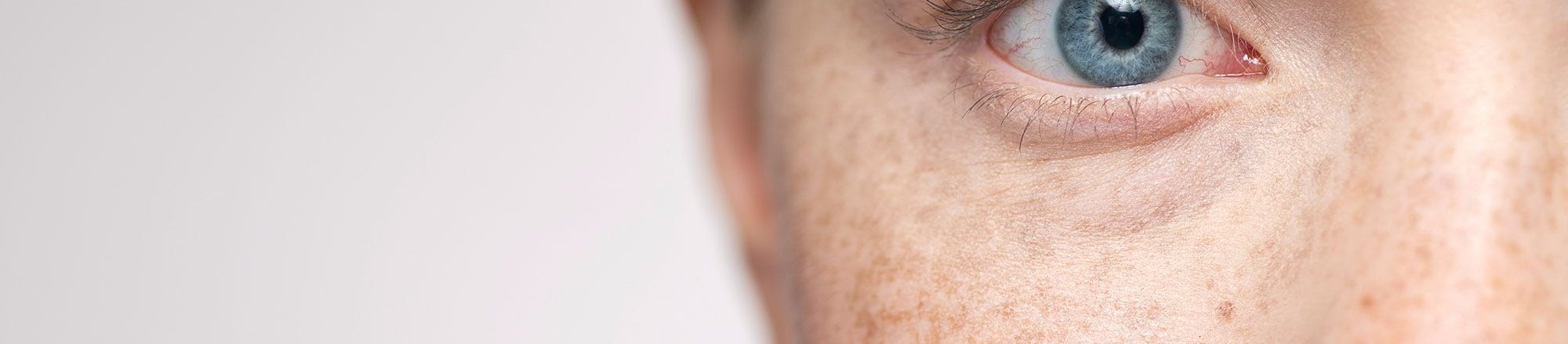 Cách phân biệt nám da và tàn nhang