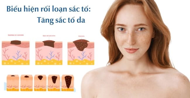 Tăng sắc tố da