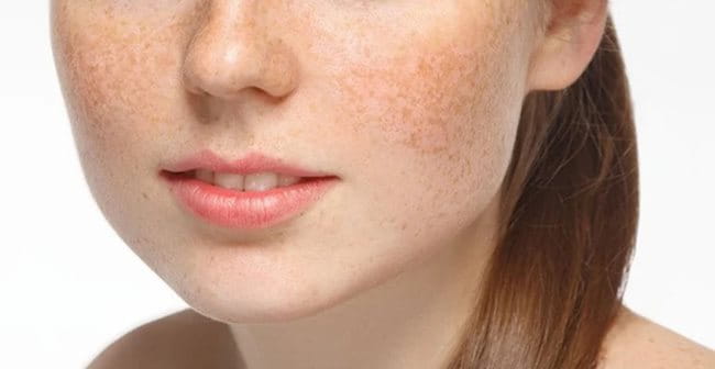 Nám, tàn nhang là một biểu hiện của tình trạng tăng sắc tố da