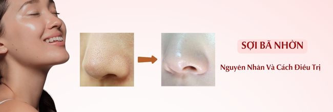 sợi bã nhờn là gì