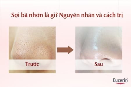 sợi bã nhờn là gì?