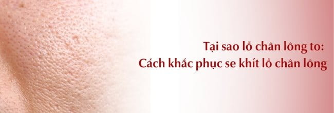 Tại sao lỗ chân lông to? Cách khắc phục