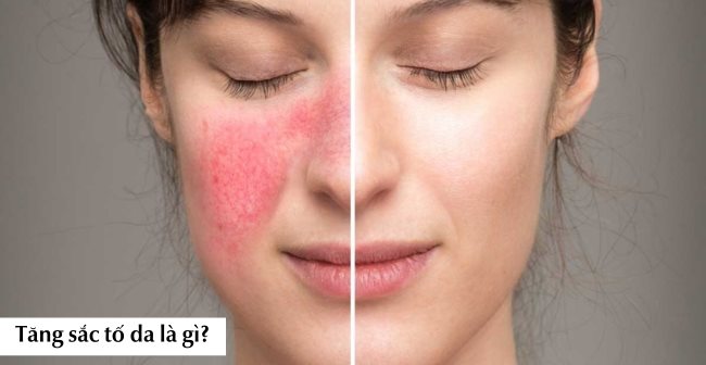 Tăng sắc tố da là tình trạng mảng da sậm màu hơn so với vùng da khác