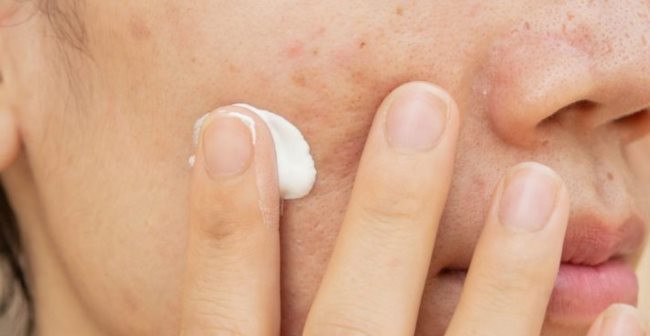 Sử dụng thuốc trị tăng sắc tố da ở mặt