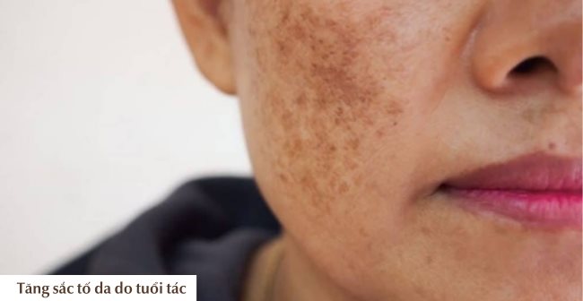 Nguyên nhân tăng sắc tố da do tuổi tác