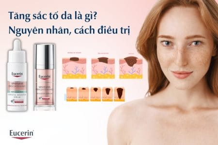 Tăng sắc tố da là gì? Nguyên nhân, biểu hiện, cách điều trị