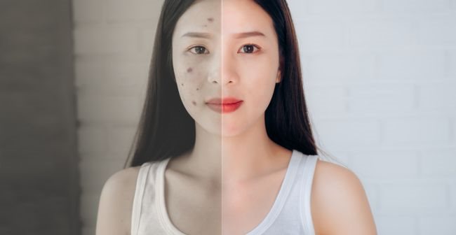 Biểu hiện của tình trạng tăng sắc tố sau viêm