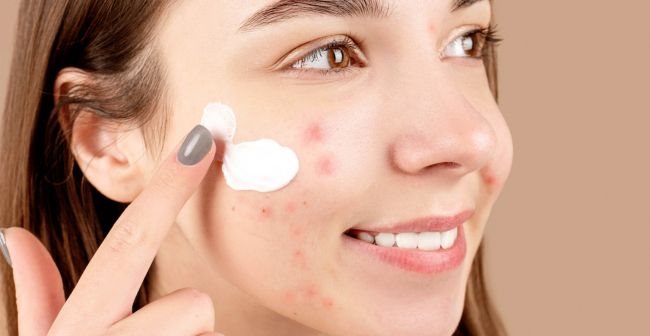 Cách điều trị tăng sắc tố sau viêm hiệu quả
