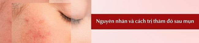 Thâm đỏ sau mụn: Nguyên nhân, cách điều trị hiệu quả