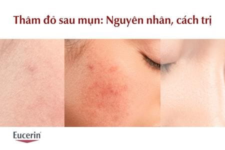 Nguyên nhân và cách trị thâm đỏ sau mụn hiệu quả