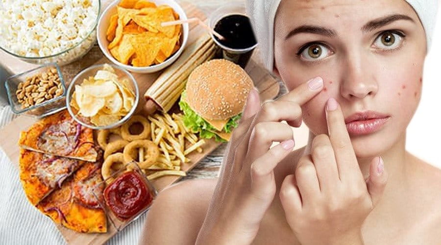 thói quen xấu gây mụn