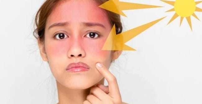 Tia UV kích thích sản sinh melanin gây hiện tượng cháy nắng 