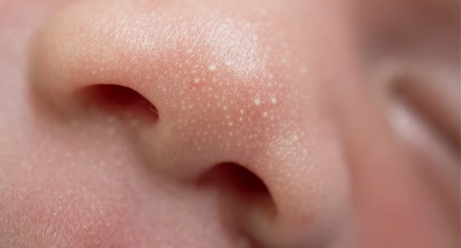 cách trị mụn đầu trắng