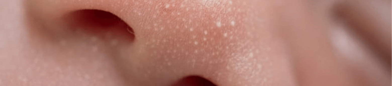 cách trị mụn đầu trắng