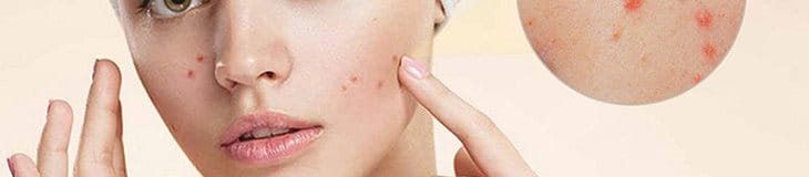 trị mụn bằng laser