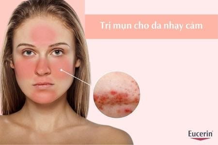 Trị mụn cho da nhạy cảm