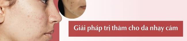 Cách trị thâm cho da nhạy cảm an toàn, hiệu quả