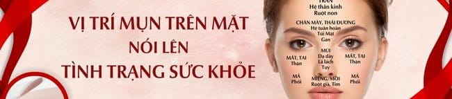 vị trí mụn