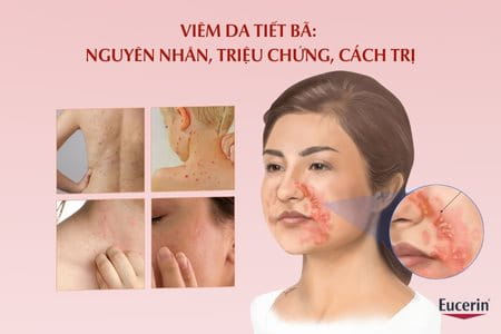 bệnh viêm da tiết bã