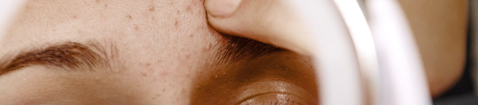 tipos de acne