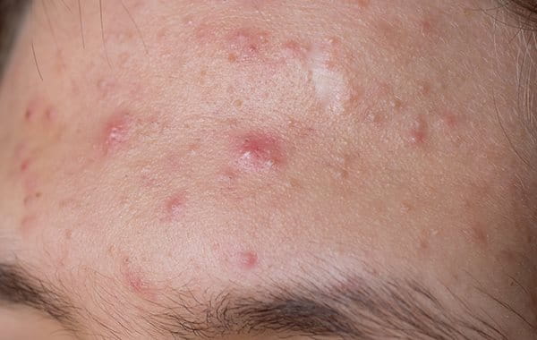 Close up image of forehead acne