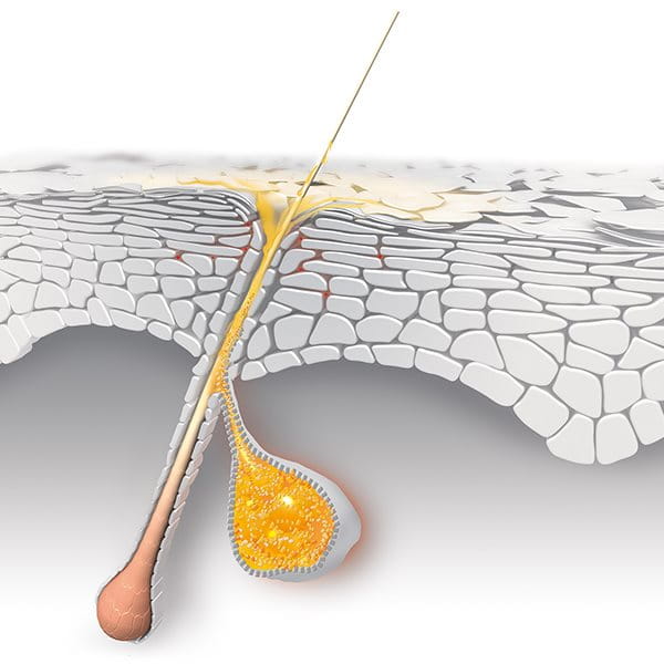 "Hormones stimulate excess sebum production which can cause acne"