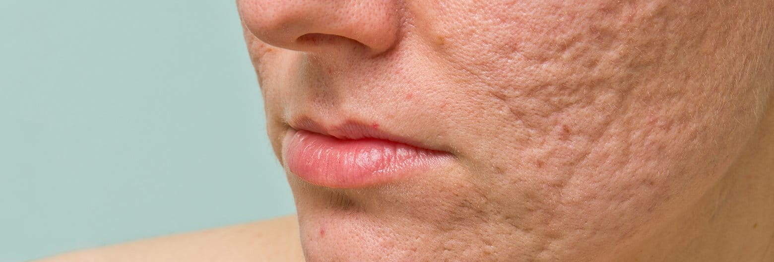 close up image of acne scarring
