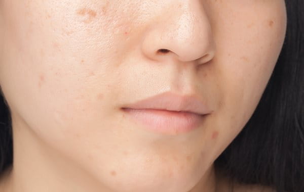 Pimple marks and scars causes by acne
