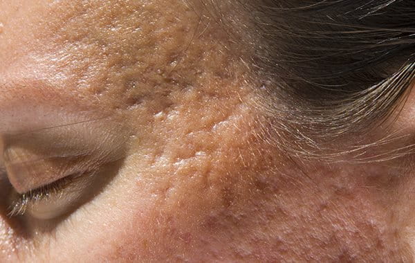 Ice pick scars are one of the types of acne scars