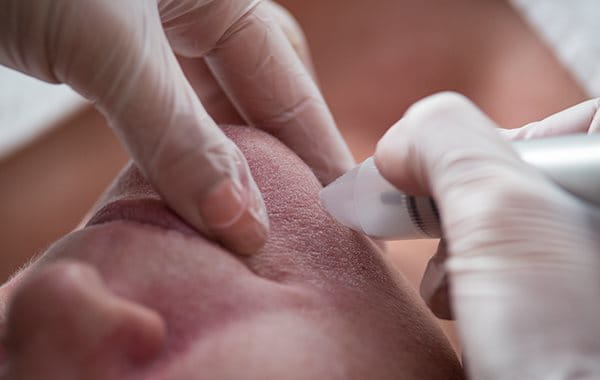 image of a person getting laser for their acne scars